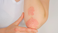 Eczema